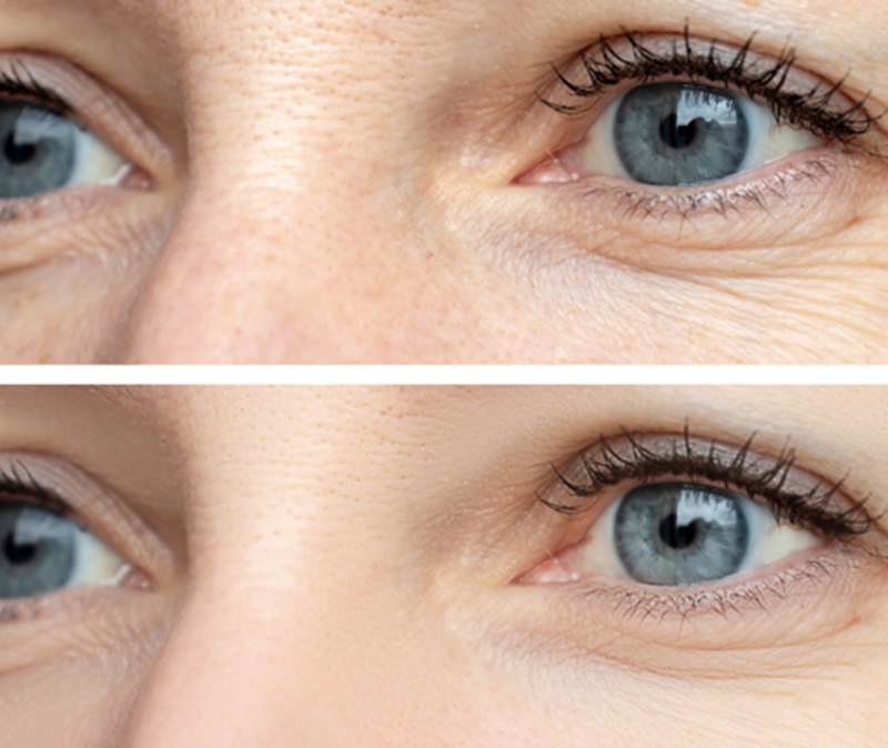 crow’s feet around eyes before and after BOTOX treatment 