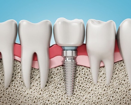 Illustration of dental implant in jawbone