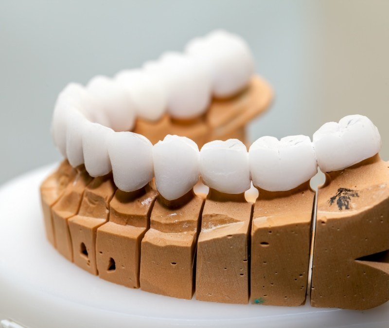 Model smile with metal free dental restorations