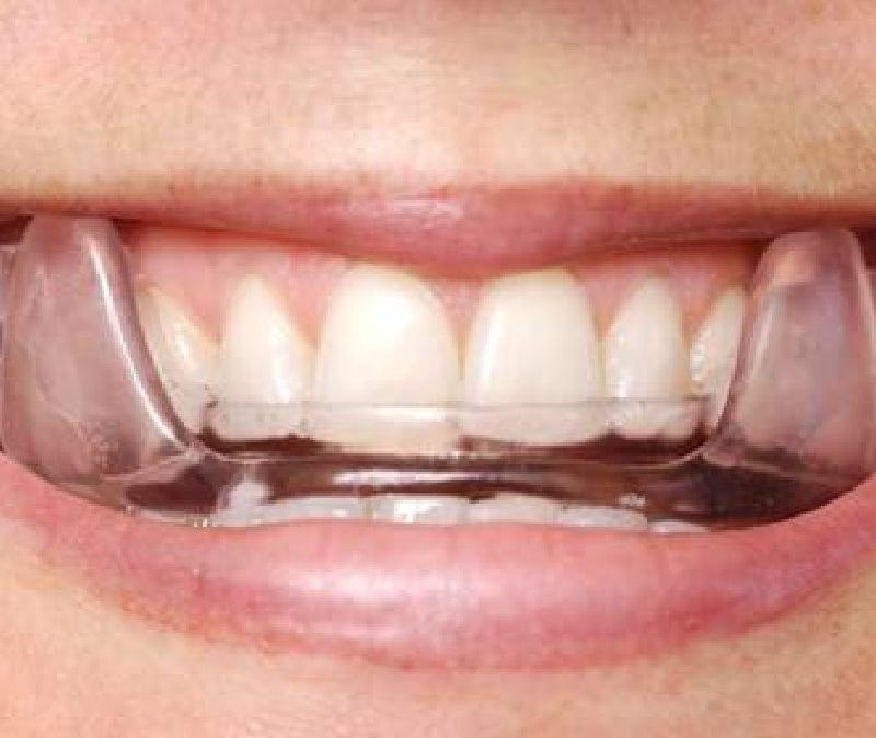 Closeup of smile with oral appliance in place