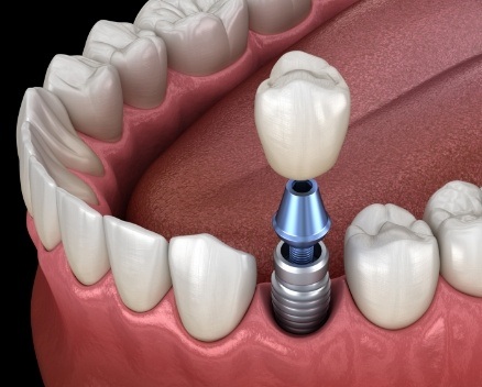 Animated smile during dental implant supported dental crown placement