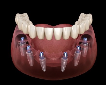 Animated smile during dental implant supported denture placement