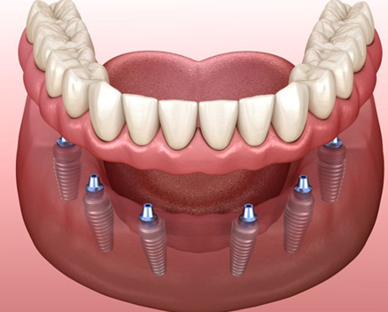 Illustration of implant denture for lower dental arch