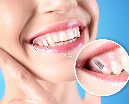 Woman’s smile with a dental implant to replace a missing tooth