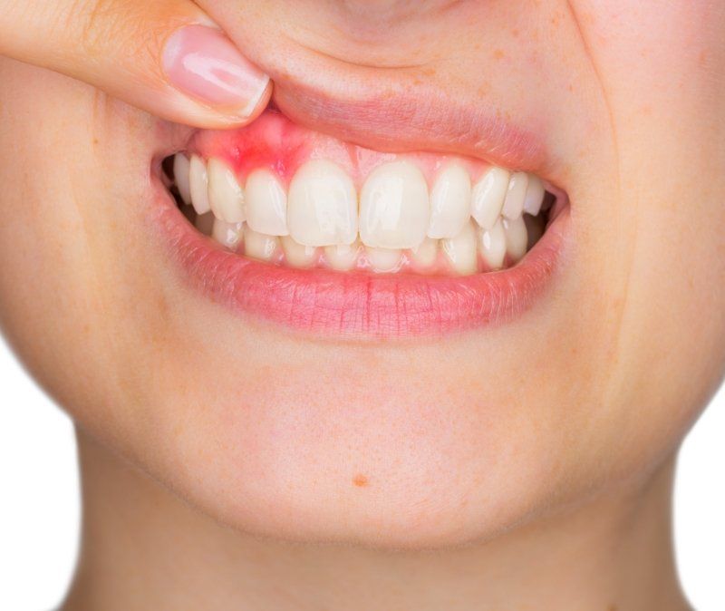 Closeup of damaged smile before gum disease treatment
