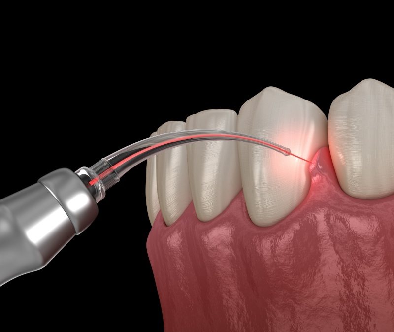 Animated smile during soft tissue laser treatment