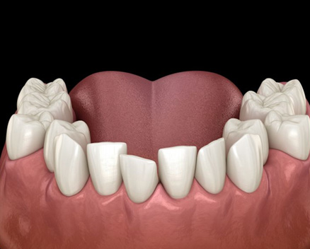 Illustration of crowded teeth in lower dental arch