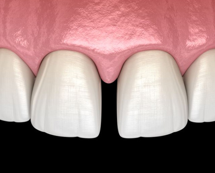 Illustration showing a gap between two front teeth