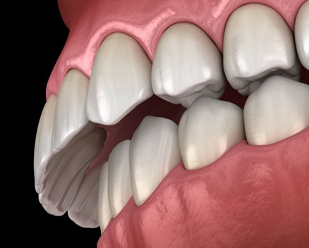 Illustration of an overbite viewed from low angle