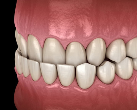 Illustration of an underbite viewed against dark background
