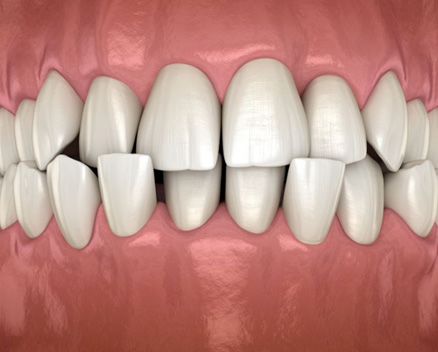 Illustration showing a crossbite