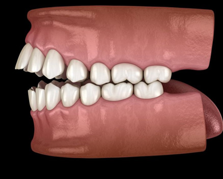 Illustration of an open bite viewed from the side