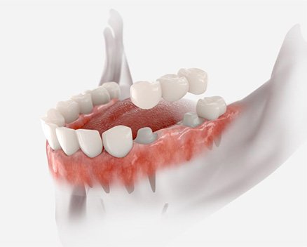 Illustration of dental bridge being placed on prepared teeth