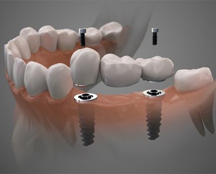 Illustration of three-unit dental implant bridge
