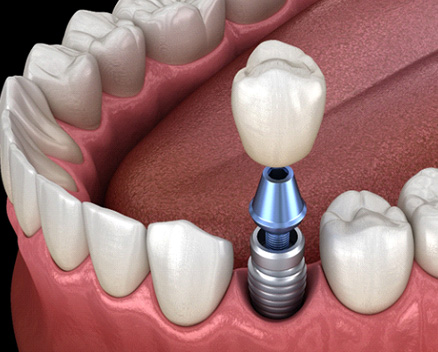 Illustration of dental implant, abutment, and crown between natural teeth