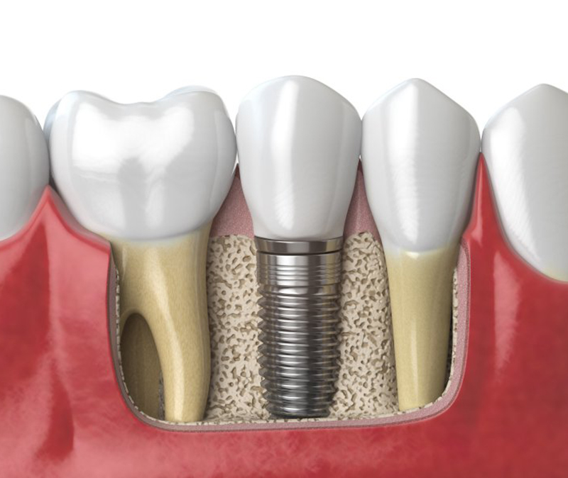 Digital illustration of a dental implant in Beachwood after placement