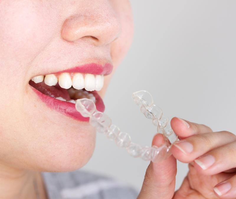 Woman placing an Invisalign tray