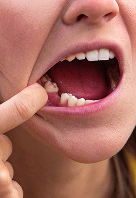 Woman missing a tooth