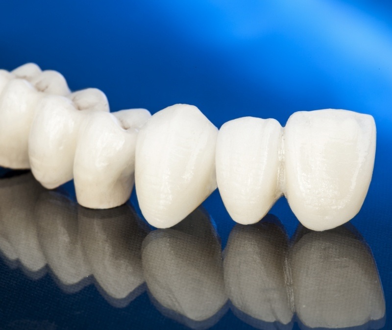 Metal free dental restoration prior to placement