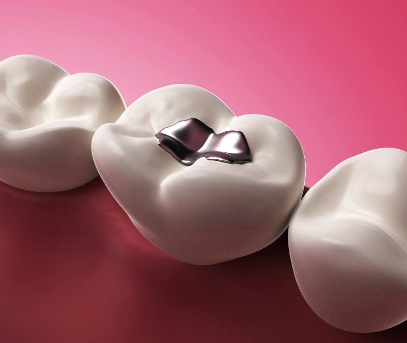 Animated smile with metal amalgam filling