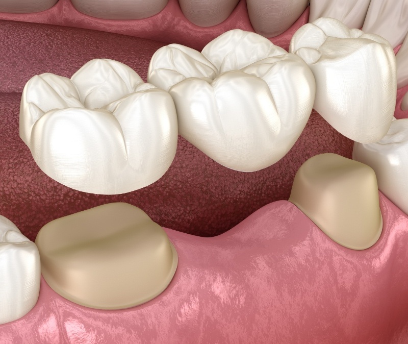 Animated smile during dental implant tooth replacement