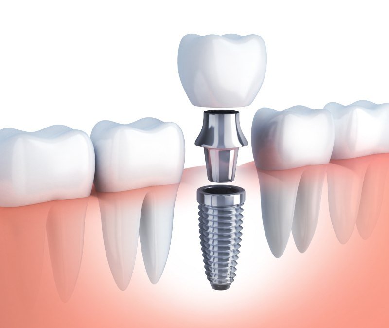 Animated smile during dental implant supported dental crown placement