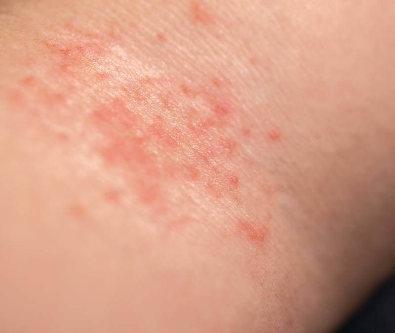 Closeup of skin symptoms of mercury poisoning