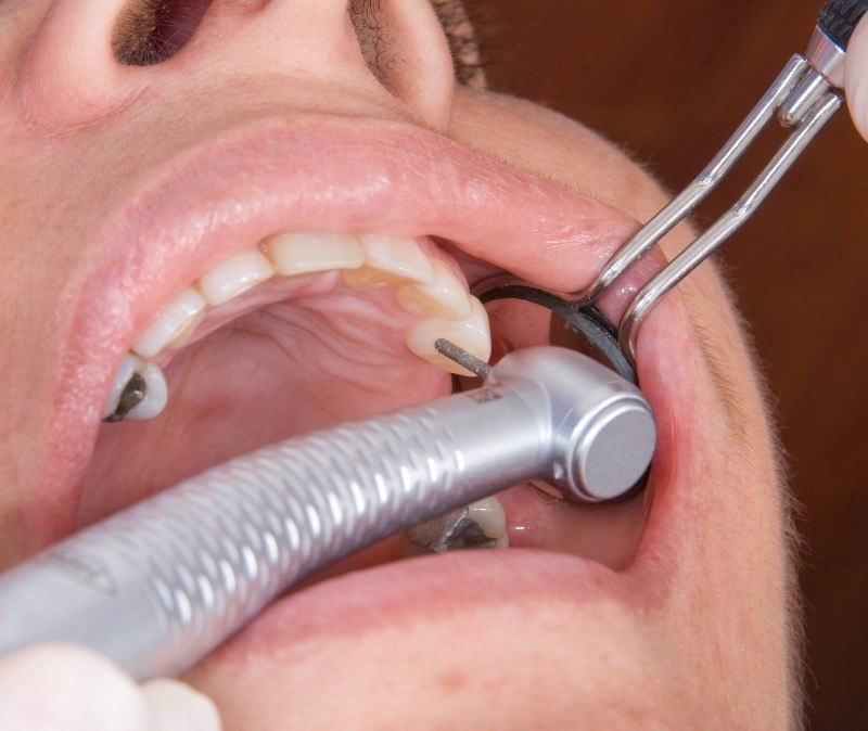 Closeup of patient during the safe amalgam removal process