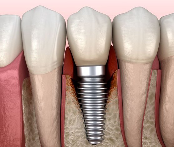 Digital image of infected tissue around a dental implant