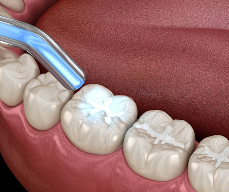 Dental curing light being used to harden a filling