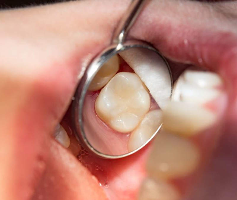 Dental mirror showing close-up view of a tooth