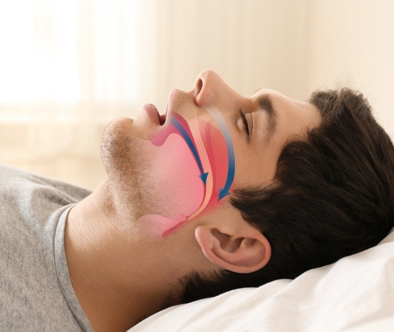 Sleeping man with animation of obstructive sleep apnea over his facial profile