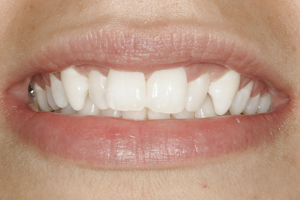 Teeth1 The Center for Advanced Dentistry #39 s Blog