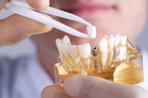 Dentist in Beechwood places dental implants