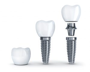 What makes a patient perfect for dental implants in Beachwood?