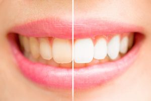 Teeth before and after teeth-whitening.