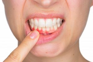 A woman pulling her lip to expose her gums.