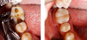 Teeth before and after receiving tooth-colored fillings.