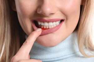 A woman with gum disease. 