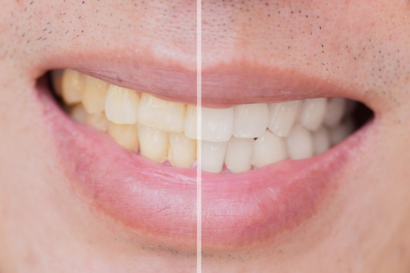 Closeup of smile before and after treatment for stained teeth