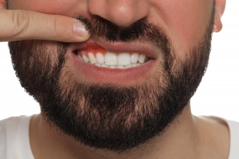 Man with gum disease lifting his lip to show gums
